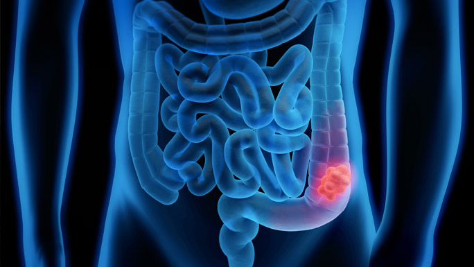 March is Colorectal Cancer Awareness Month 